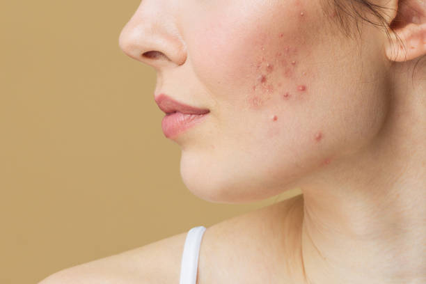 Acne Scar