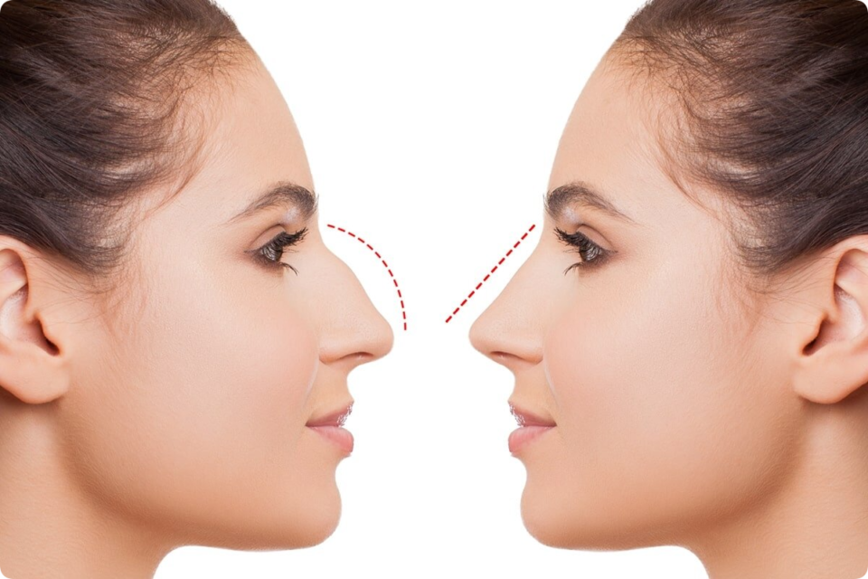 Rhinoplasty in Islamabad: Your Ultimate 2024 Guide