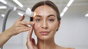 Tech Skin Peeling