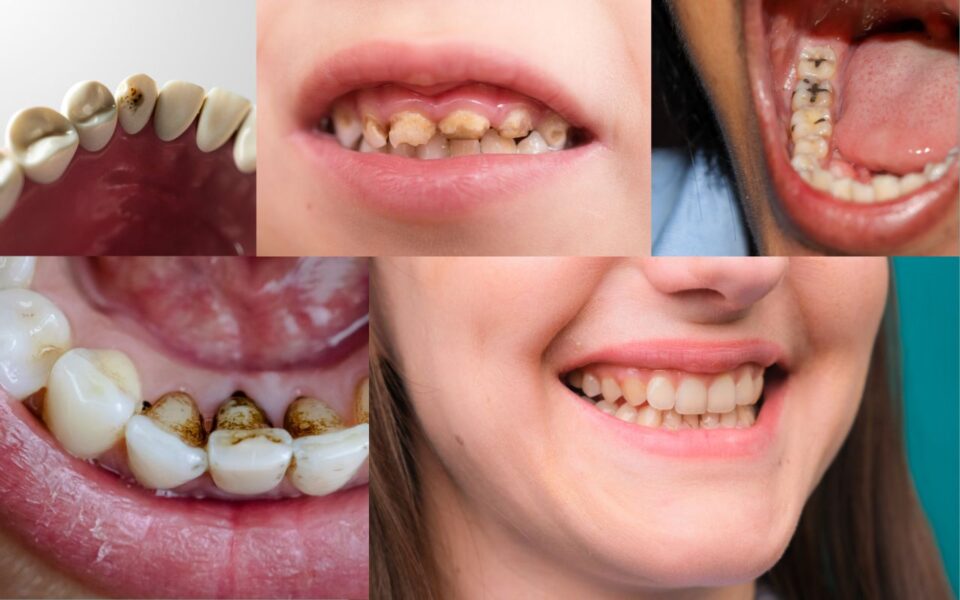 Brown Stains on Teeth