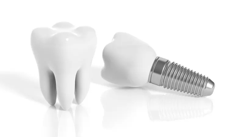How Long Does It Take for Dental Implants to Heal?